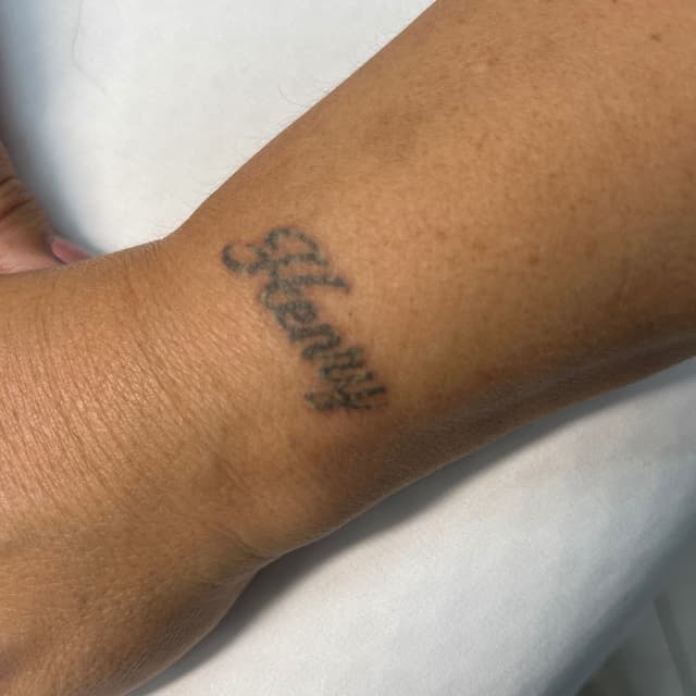 Small Tattoo Removal at Flow Ink & Beauty in Henderson, NV